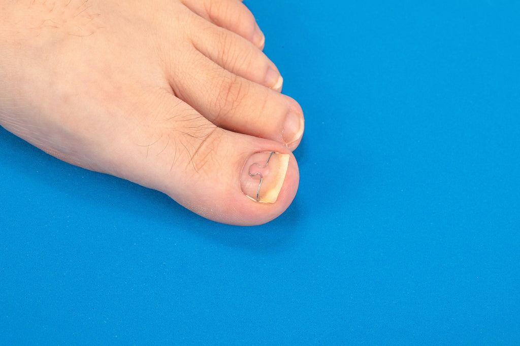 UV Shoe Sanitizer - Getting Rid of Nail Fungus for Good