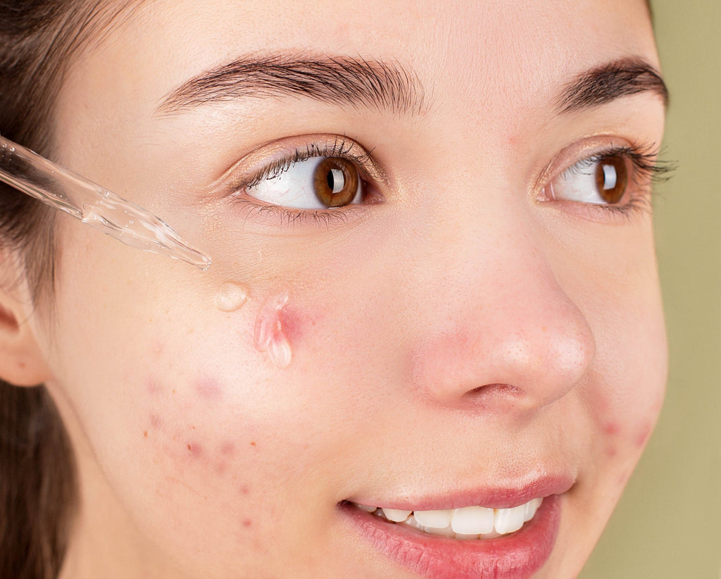 Best Acne Spot Treatment: Top Picks for Clear Skin