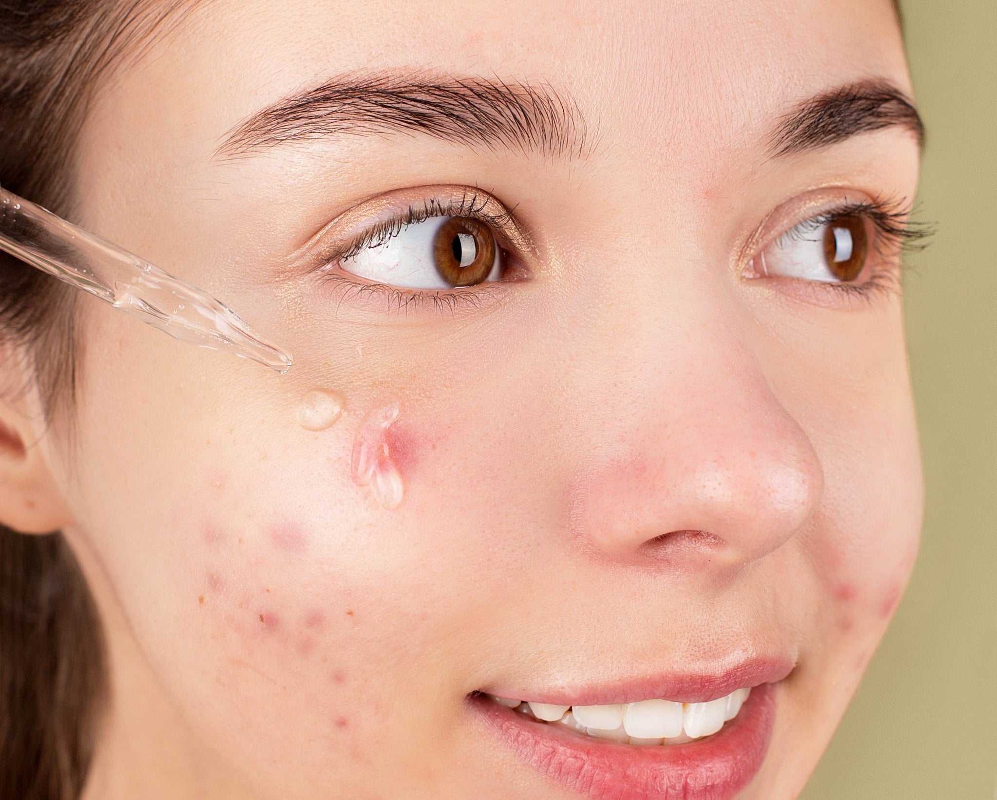 Best Acne Spot Treatment Top Picks For Clear Skin Girlboss 4421